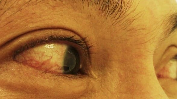 Picture of a person's eyes with conjunctivitis (red eyes).