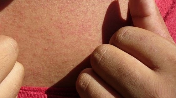 Photograph of a person's skin with a rash caused by Zika.