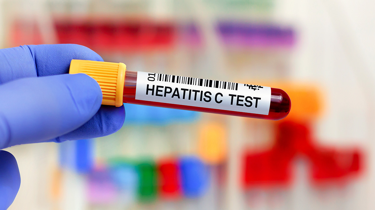 A medical sample in a test tube that is labelled "Hepatitis C Test"