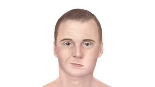 Illustration of a man displaying facial palsy symptoms