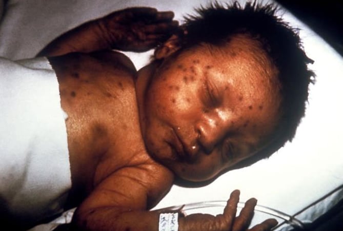 Infant with what is referred to as blueberry muffin skin lesions, which was indicative of congenital rubella.